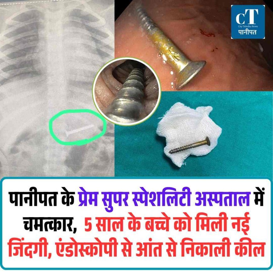 पानीपत के प्रेम सुपर स्पेशलिटी अस्पताल में चमत्कार, एंडोस्कोपी से 5 साल के बच्चे की आंत से निकाली कील